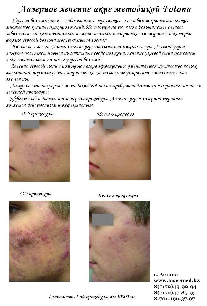 Лечим акне в домашних условиях 42