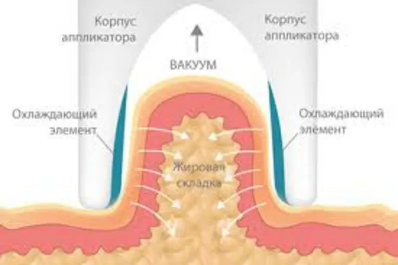 Криолиполи3-  инновационная безболезненная методика,  позволяющая избавиться от жировых отложений под воздействием холода.  5