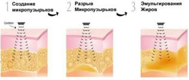 КАВИТАЦИЯ - ультра3вуковое во3действие на жировую клетку.эффект с первой процедуры 2